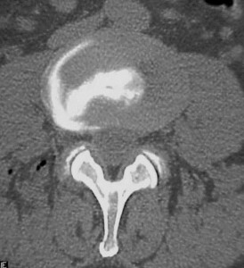 CT-dicogram